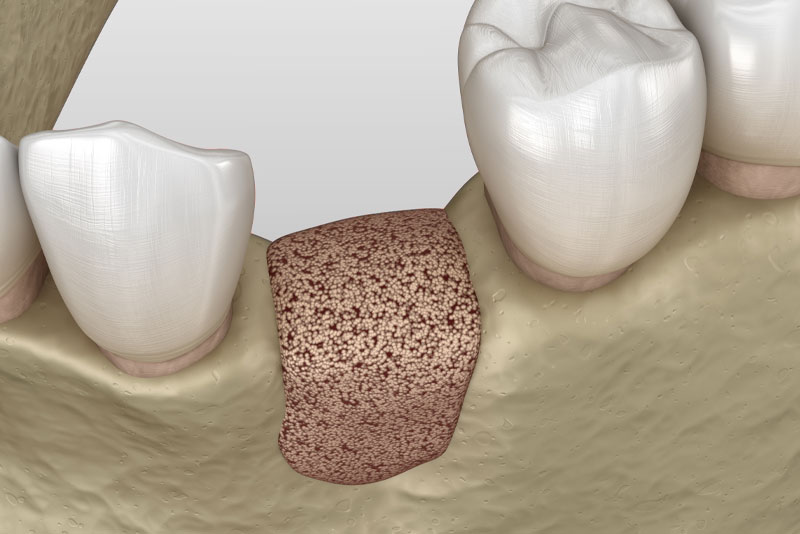 bone graft graphic