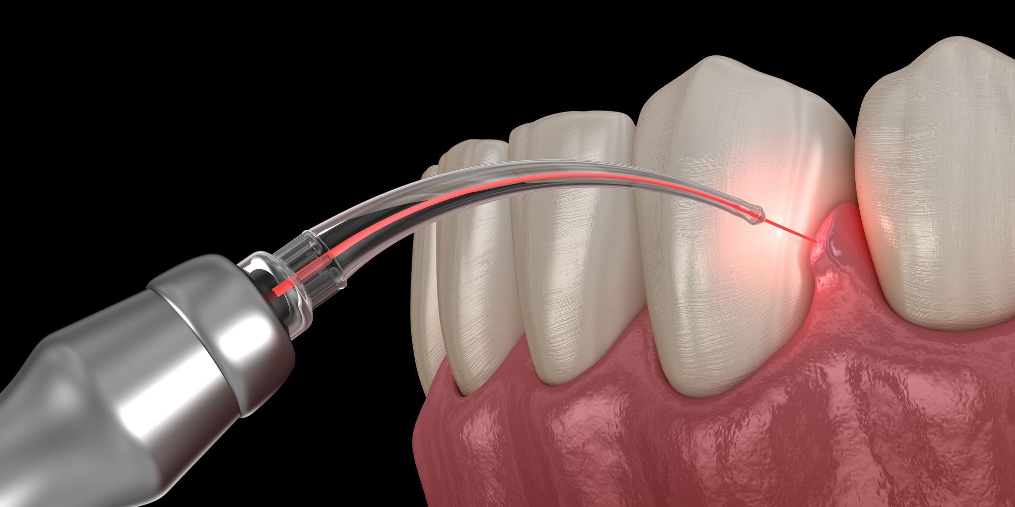 dental laser