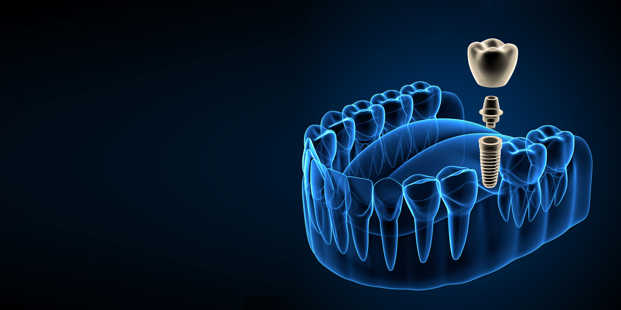 dental implant model 3d with full set of teeth